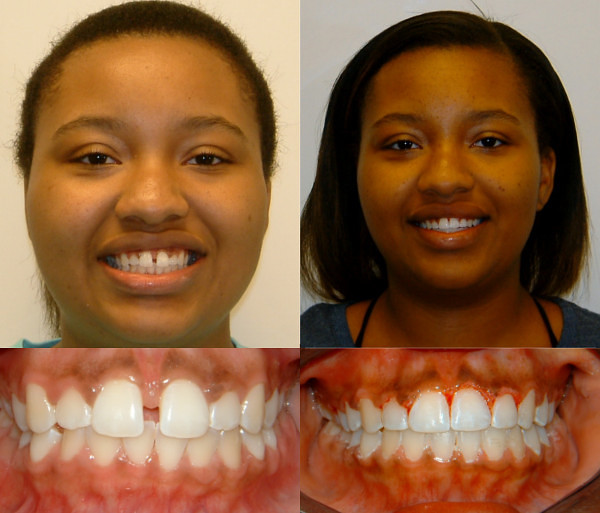 overbite before and after